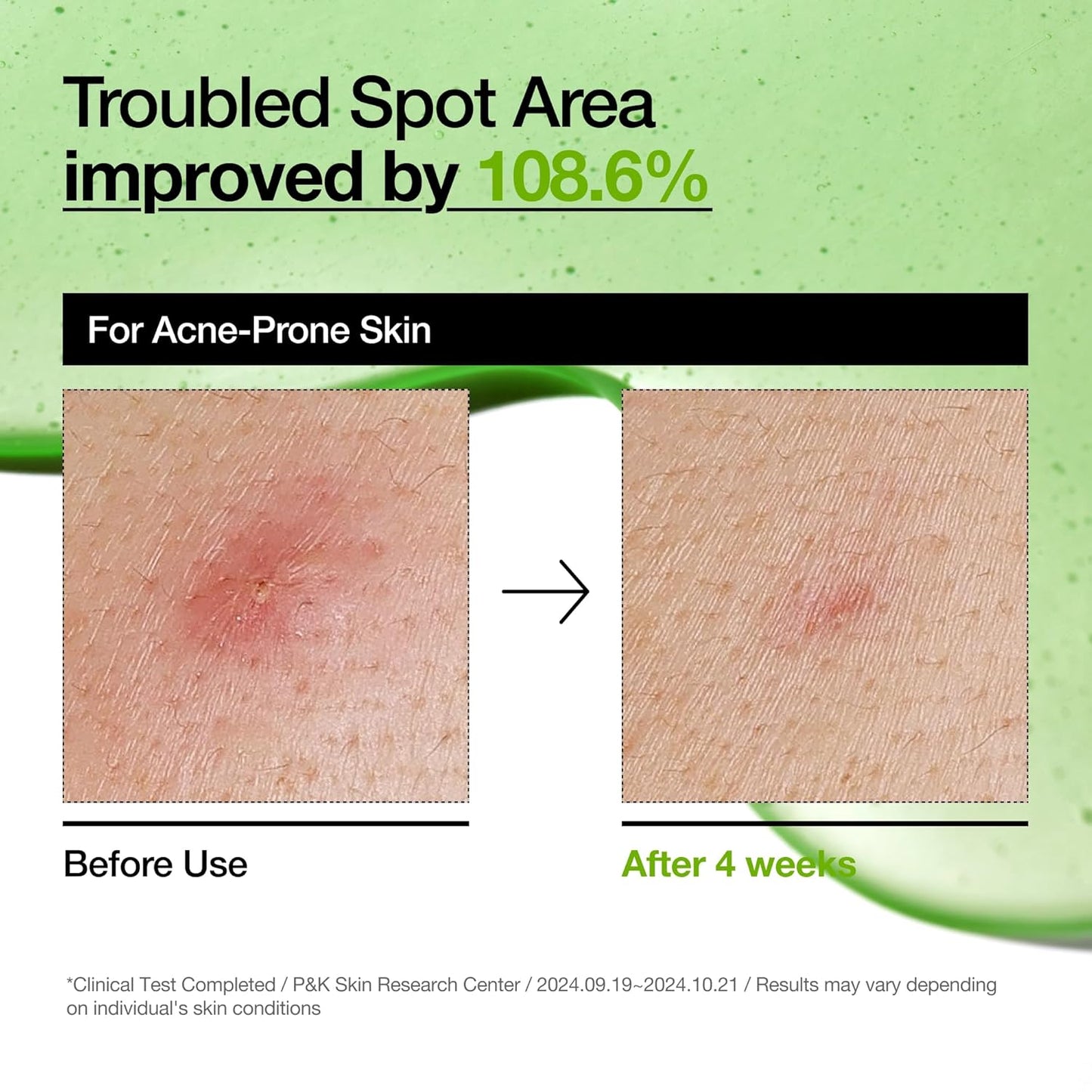 Anua Azelaic Acid 10+ Hyaluron